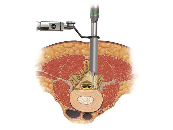 Spine Treatment in Jaipur