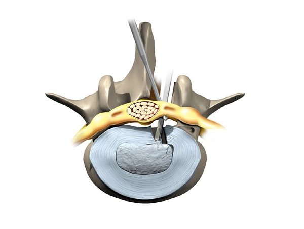 Spine Treatment in Jaipur